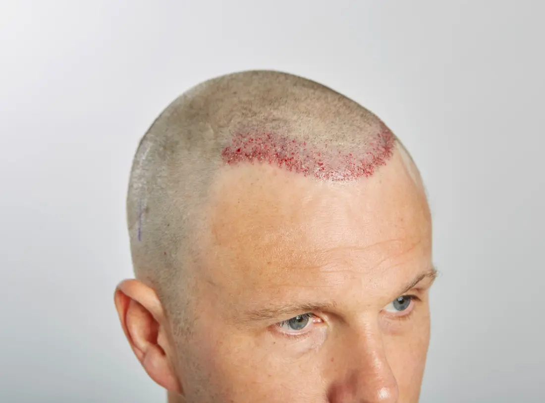 Immediately post op – 618 FU grafts via FUE extraction